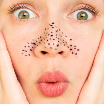 Mascarillas para el acné: ¿cómo combatirlo?