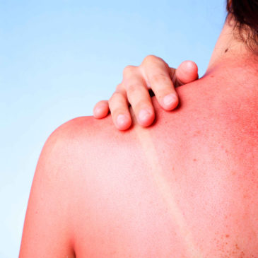 ¿Cómo tratar las quemaduras de sol? sí­ntomas y consejos