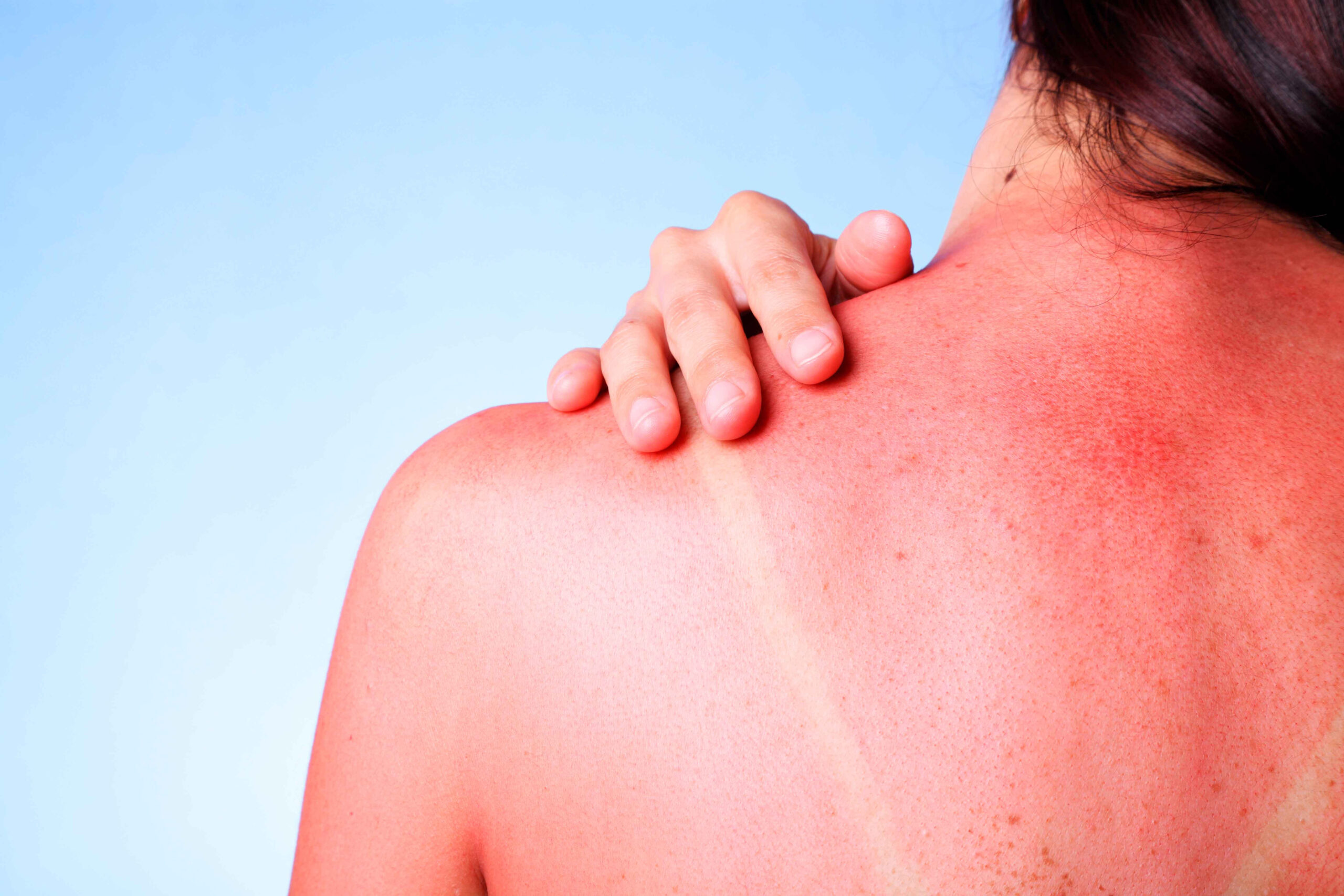 Cómo tratar las quemaduras de sol