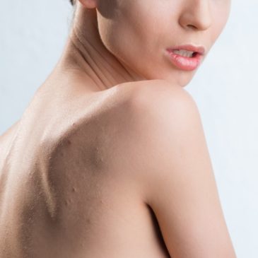 Cómo eliminar el acné en la espalda