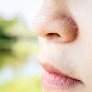 Dermatitis seborreica causas y tratamientos